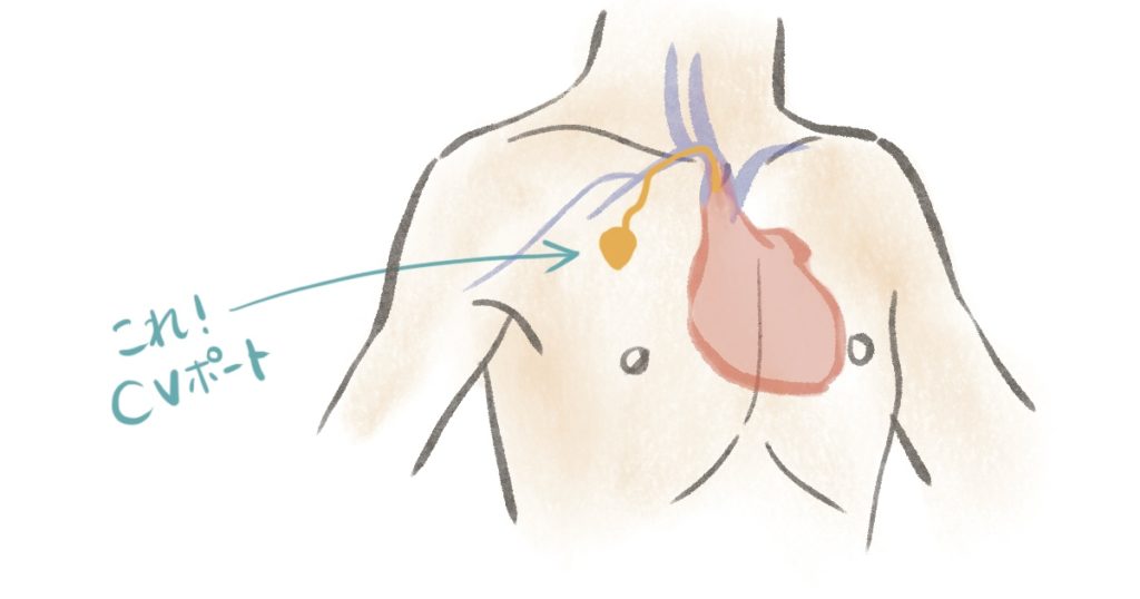 CVポートは皮下に埋まってます。